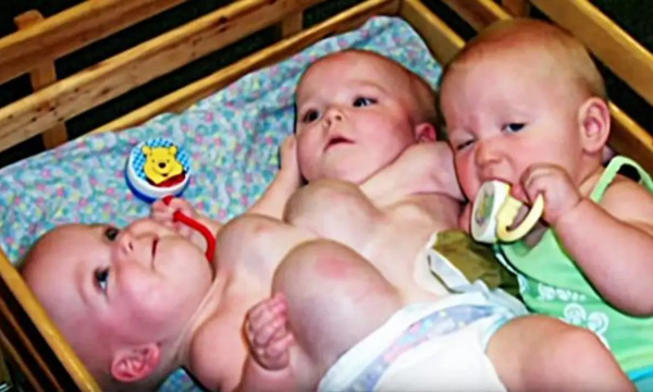 От этих тройняшек отказались родители. Вот, что случилось с сиамскими близнецами и их сестричкой